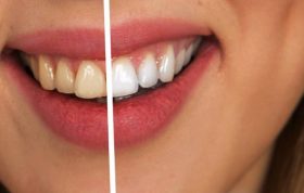 ویپینگ لبخند شما را زیبا تر می کن